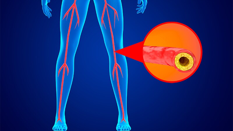 If a Saphenous Graft Is Available, Treat CLTI Surgically