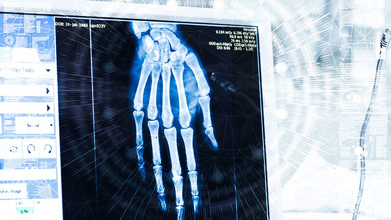 AI Efforts Make Strides in Predicting Progression to RA