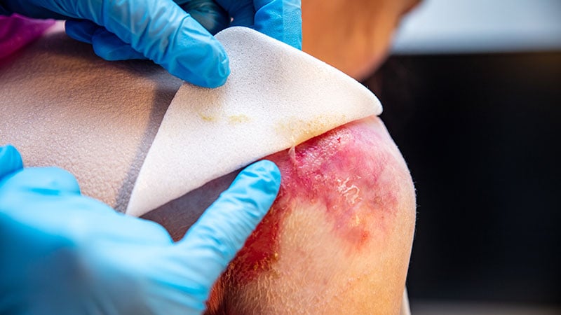 Topical Gene Therapy Gel Heals Dystrophic EB Wounds