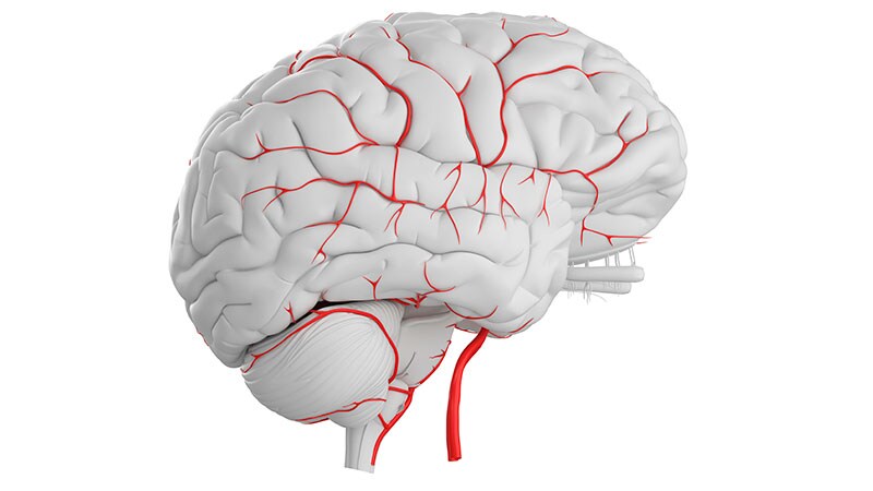 Drug Combo Promising in Vascular Cognitive Impairment: LACI-2