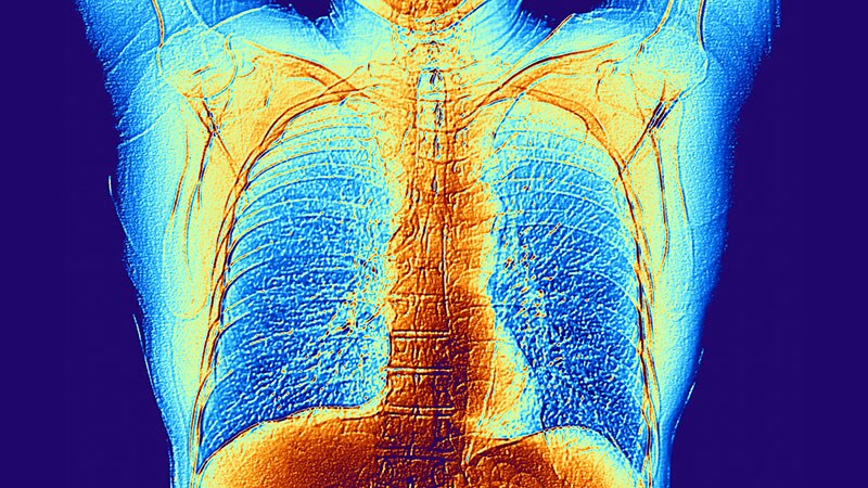 Fixed-Dose Combo Pill for PAH Promises Accelerated Benefit: A DUE