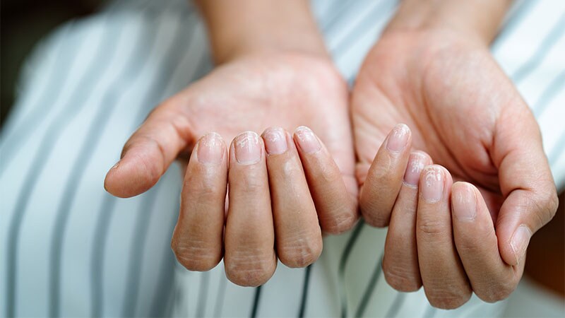 Limited Treatment Options Exist for Brittle Nail Syndrome
