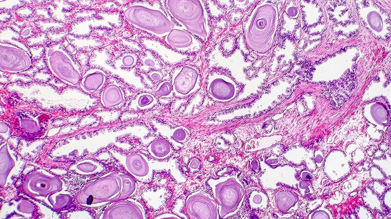 Urology Groups Endorse Two Prostate Biopsy Approaches