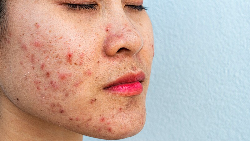 1,726-nm Laser Treatment of Acne Yields 'Impressive' Results