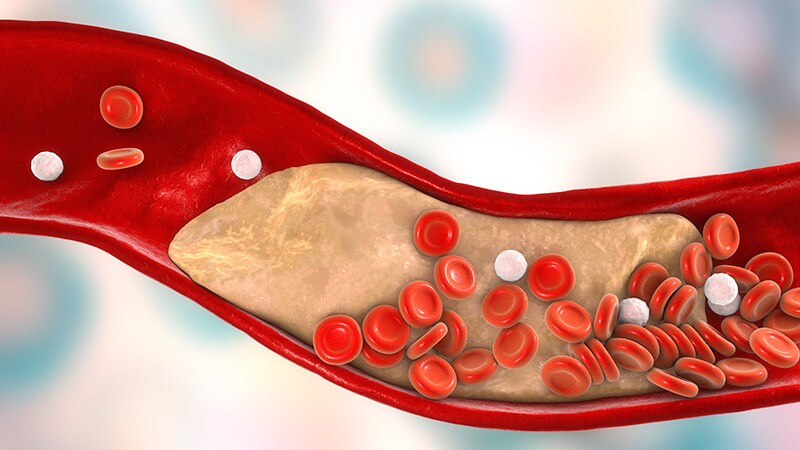 CVD Risk Tools Are Less Accurate in Patients With Arthritis