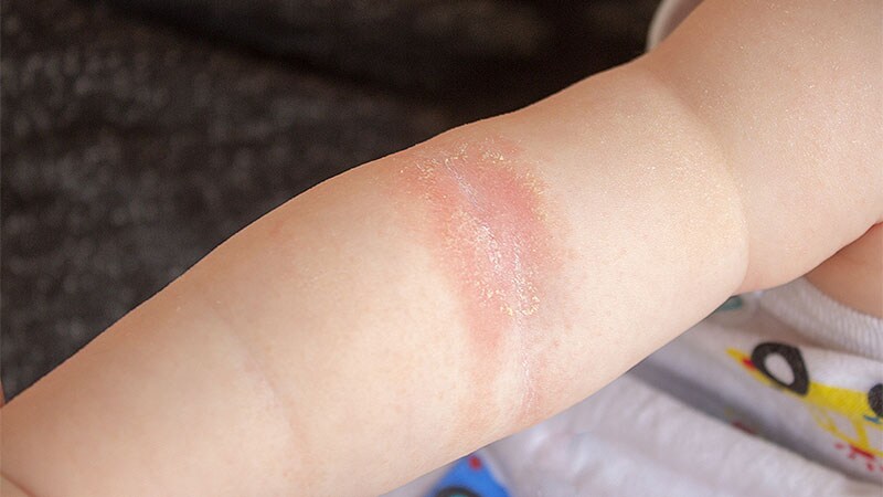 Roflumilast Cream Safe, Effective for Kids With Psoriasis