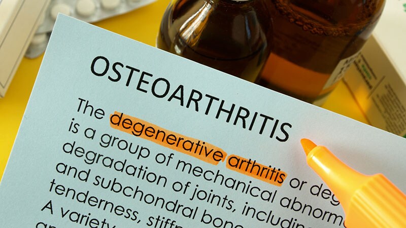 Osteoarthritis Cases Projected to Balloon Over Next 30 Years