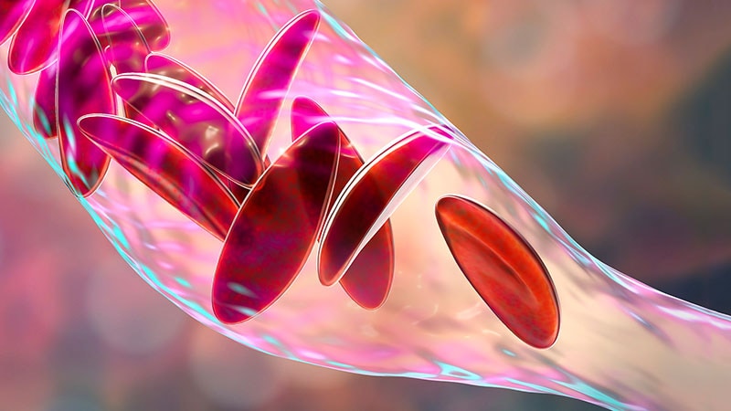 Dispelling Misconceptions About Sickle Cell Disease