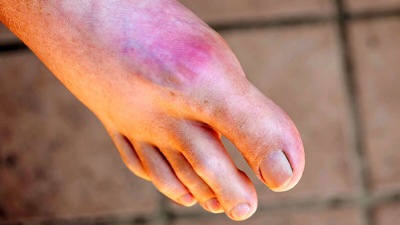 Adverse Events Compared for Gout Flare Prophylactic Drugs