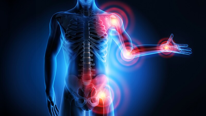 Approximately 20% of US Adults Are Diagnosed With Arthritis 