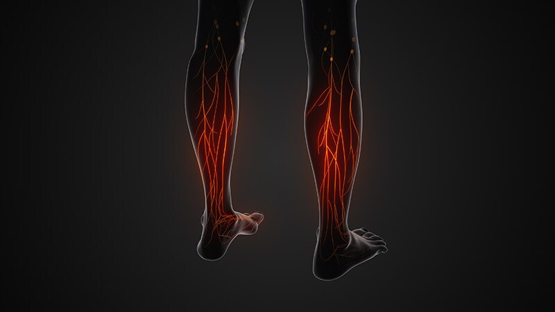 Resorbable Scaffold Beats Angioplasty in Below-Knee CLTI