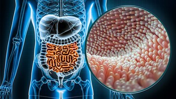 Celiac Disease and Higher Risk of Women's Health Disorders