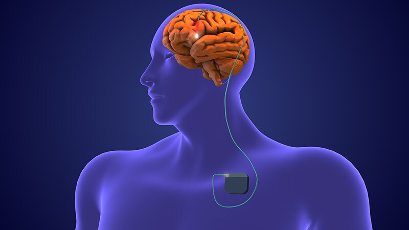 New Findings Support DBS in Parkinson's With GBA Mutation