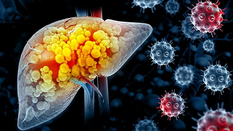 Fewer Than 1 in 4 Patients With HCV-Related HCC Get DAAs