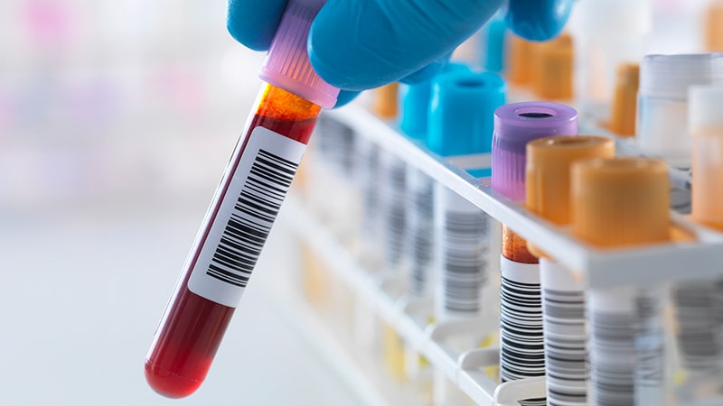 Novel Blood Test Can Detect Rheumatoid Arthritis