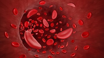 ASH 2023: Equity, Sickle Cell, and Real-Life Outcomes