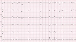 High-Risk ECGs