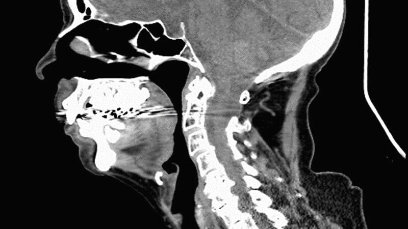 Years of Severe Exhaustion, Fatigue, and Family Stress