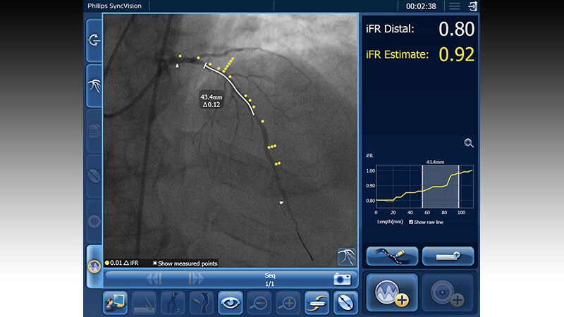 DEFINE PCI: Tightly iFR-Optimized PCI May Cut Cardiac Event Risk