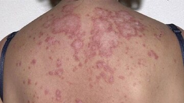 'Multimorbidity' More Commonly Seen in People With Lupus