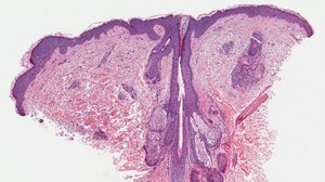 ANA Testing in a Postpartum Patient at Risk for Dermatomyositis 