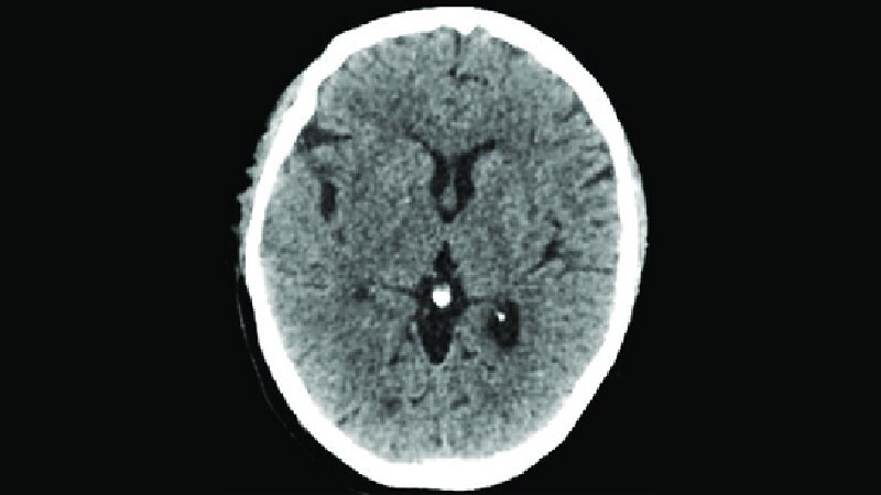 Stroke Thrombectomy Alone Fails Noninferiority to Bridging tPA