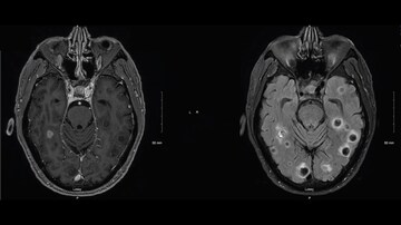  Leukocytosis in a Retiree