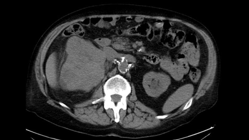 Alarming Findings Before Vasectomy