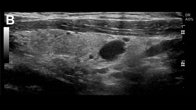 Goiter and Brain Fog in a 50-Year-Old Woman