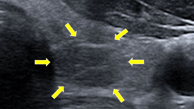 Thyroid Dysfunction May Linger a Year After Severe COVID-19