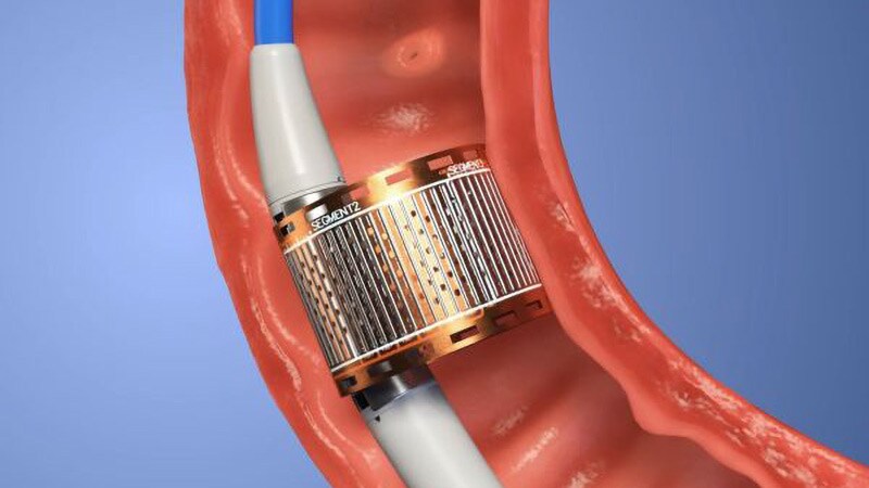 Can an Endoscopic Procedure Treat Type 2 Diabetes? 