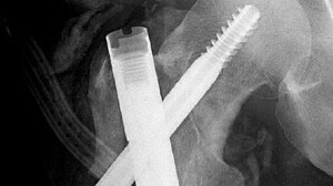 Healing Osteomyelitis After Intertrochanteric Femur Fracture