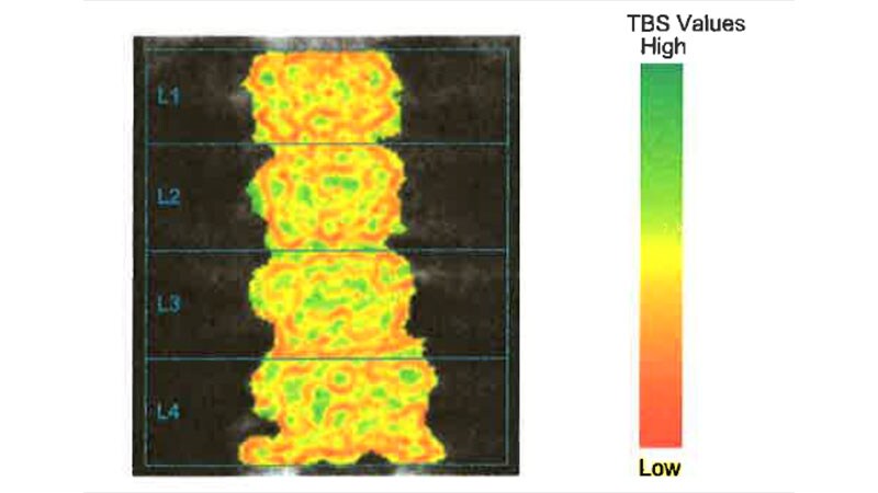Bone Degradation Measure Can Sway Osteoporosis Diagnosis