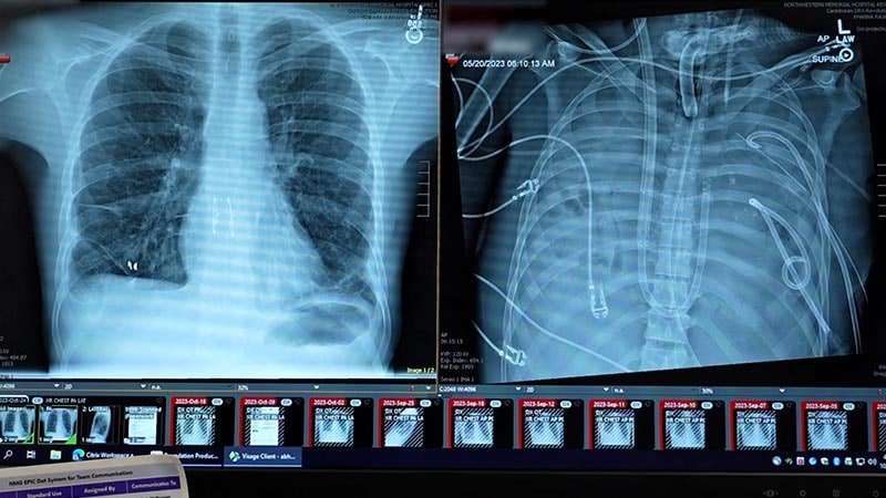 Double Lung Transplant Uses Double D Breast Implants