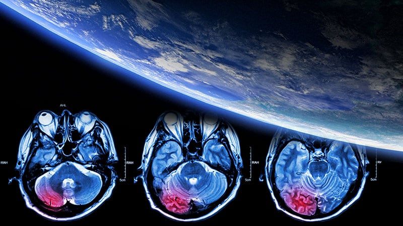 Pragmatic Solutions to 'Catastrophic' Global Stroke Burden