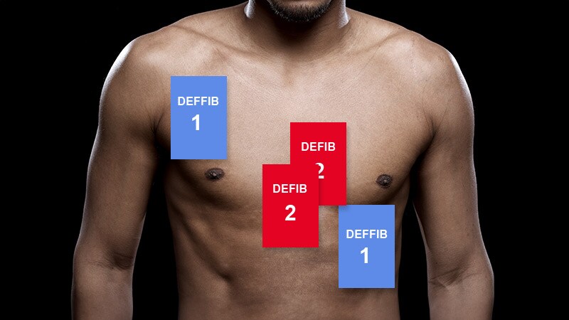 Dual Energy Conversion Safe, Reliable for AF With Obesity
