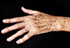 Psoriatic Arthritis Imaging: Overview, Radiography Psoriatic Arthritis Imaging: Overview, Radiography