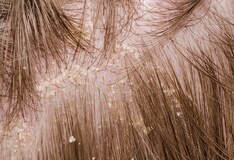 Pustular Psoriasis: Overview of Pustular Psoriasis Pustular Psoriasis: Overview of Pustular Psoriasis