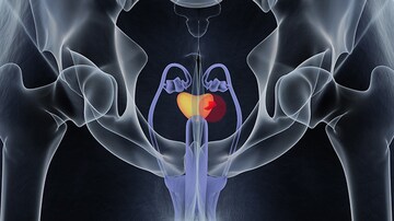 The Hidden Cost of Prostatectomy: Patient Regret