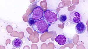 AGILE: 'Exciting' Survival Results for IDH1-mutated AML