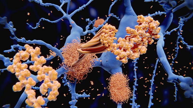 Novel Antibody May Reduce Amyloid, Cut AD Symptoms