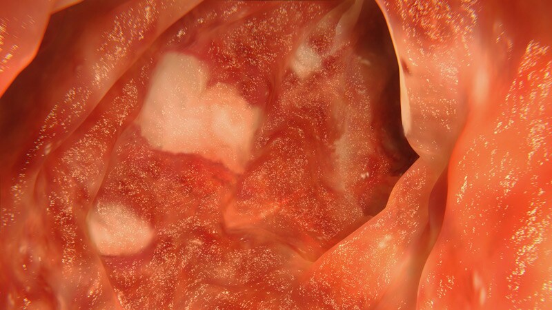 Fewer Discontinuations With Infliximab for UC Maintenance Tx