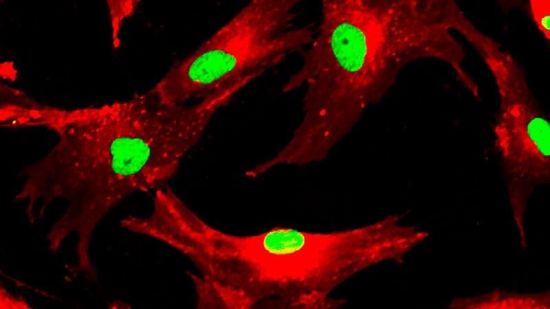 Negative Stem Cell Results in HF May Still Have Promise: DREAM-HF