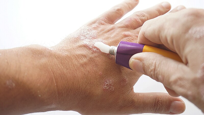  YouTube Content on Topical Steroid Withdrawal Subpar Study Finds