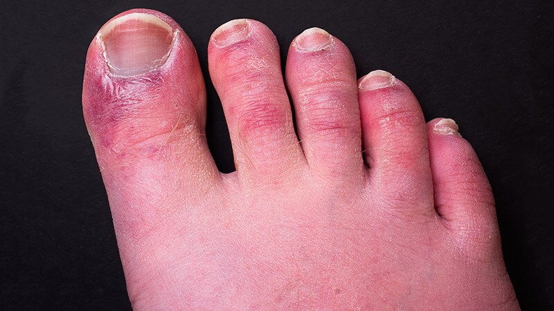 Skin Symptoms Common in COVID 'Long-Haulers'