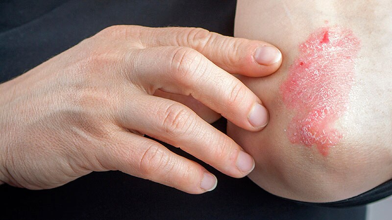 Mirikizumab Beats Placebo, Secukinumab for Psoriasis