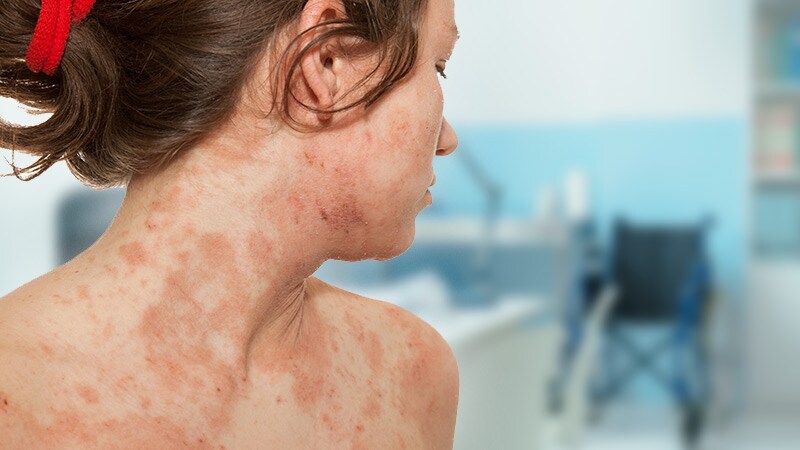 No Lab Monitoring Needed in Adolescents on Dupilumab