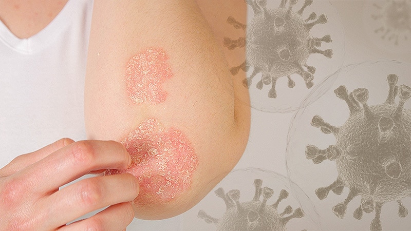 Biologics May Protect Patients With Psoriasis Against Severe COVID