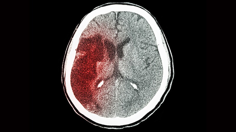 Target Ticagrelor to Minor Stroke, TIA Patients With AS