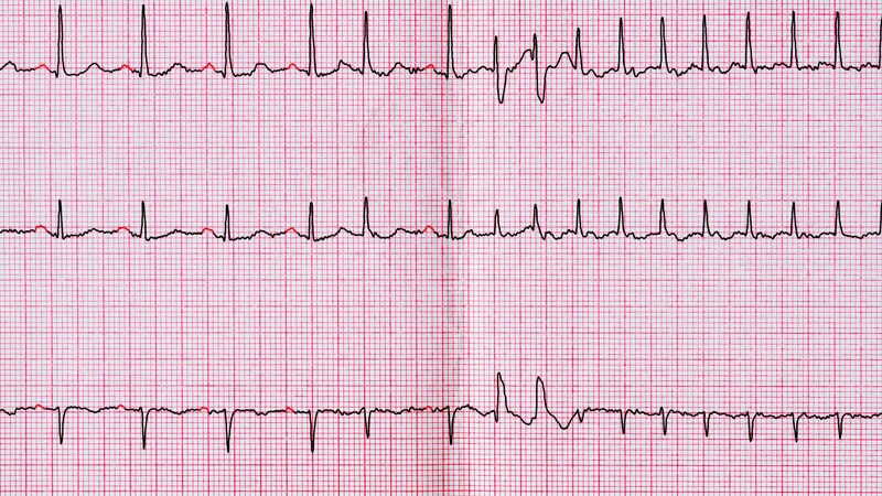 ECG Increases AF Detection, but Not Anticoagulation, After Stroke